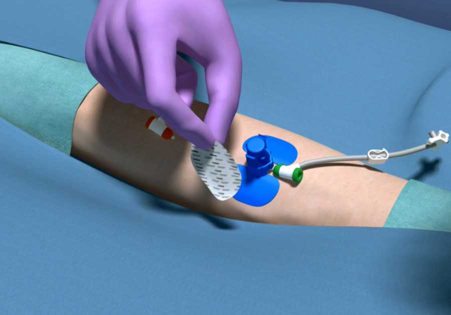 Medical device animation
