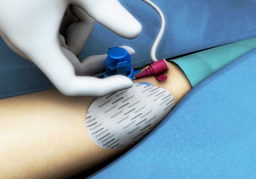 Radial Artery Catheterization Medical Device Animation