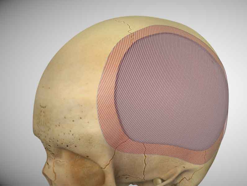 3d medical illustration for cranioplasty