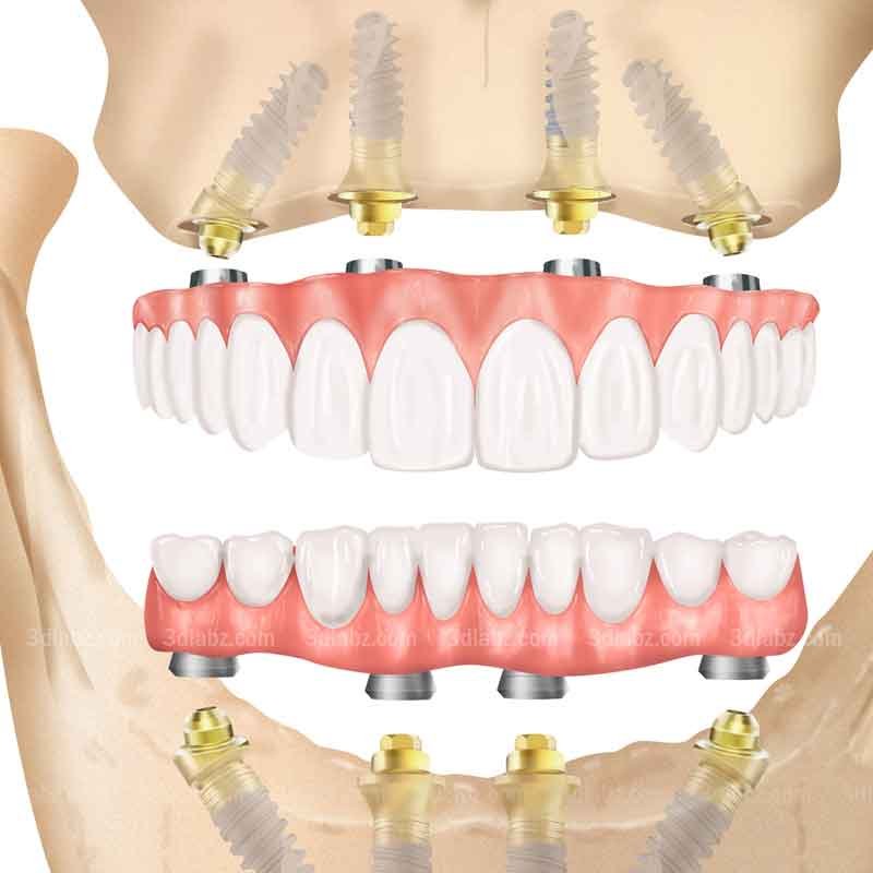 A medical illustration showing all on 4 dental implant procedure