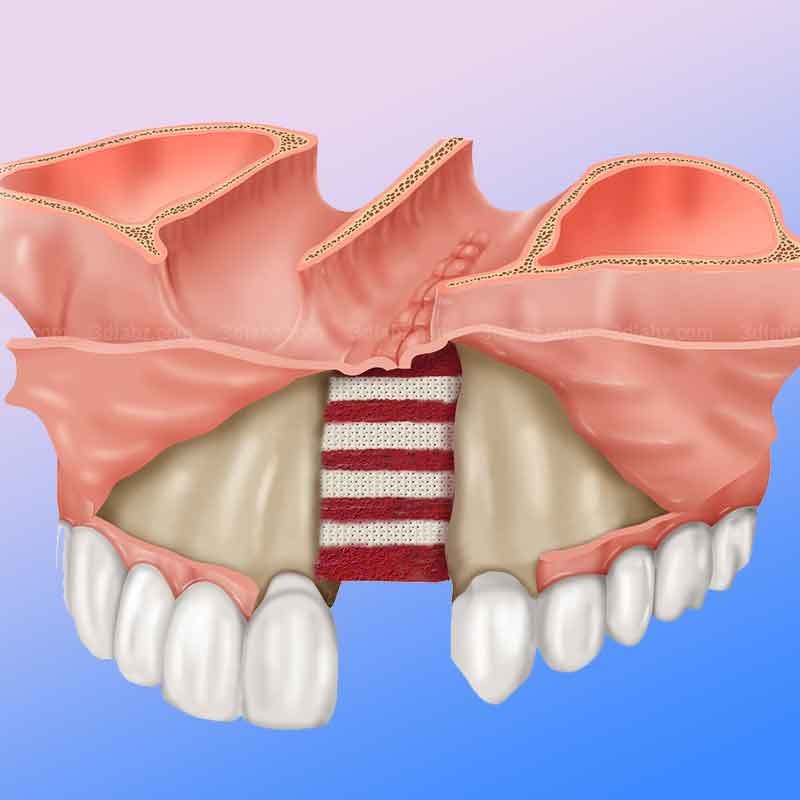 2d medical illustration showing alveolar cleft bone graft