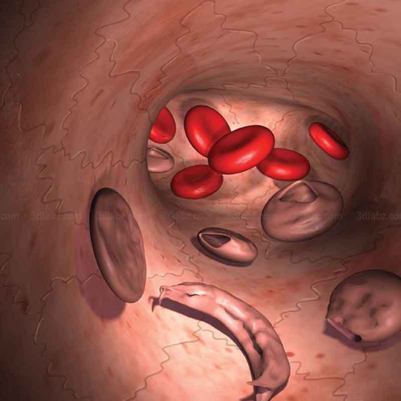 A 3D medical rendering showing anemia