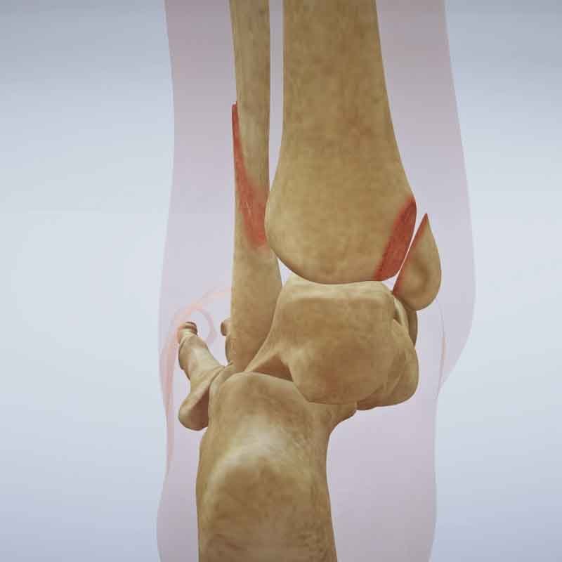 A 3D render image showing fractured ankle