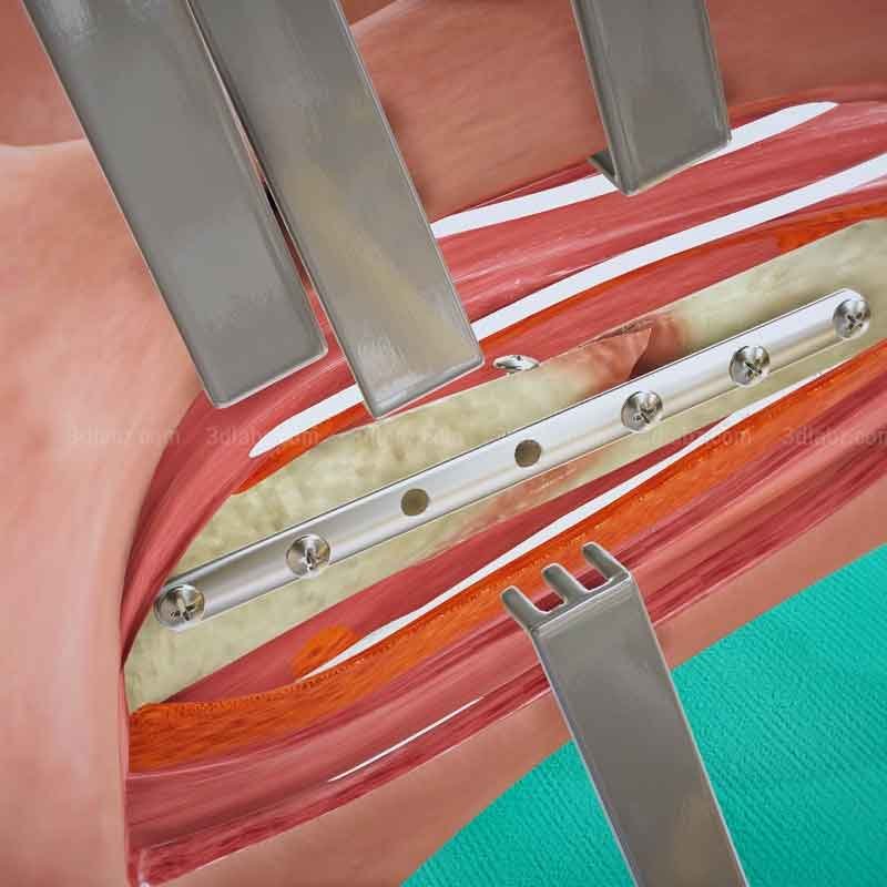 A 3D render showing ankle open reduction internal fixation surgery
