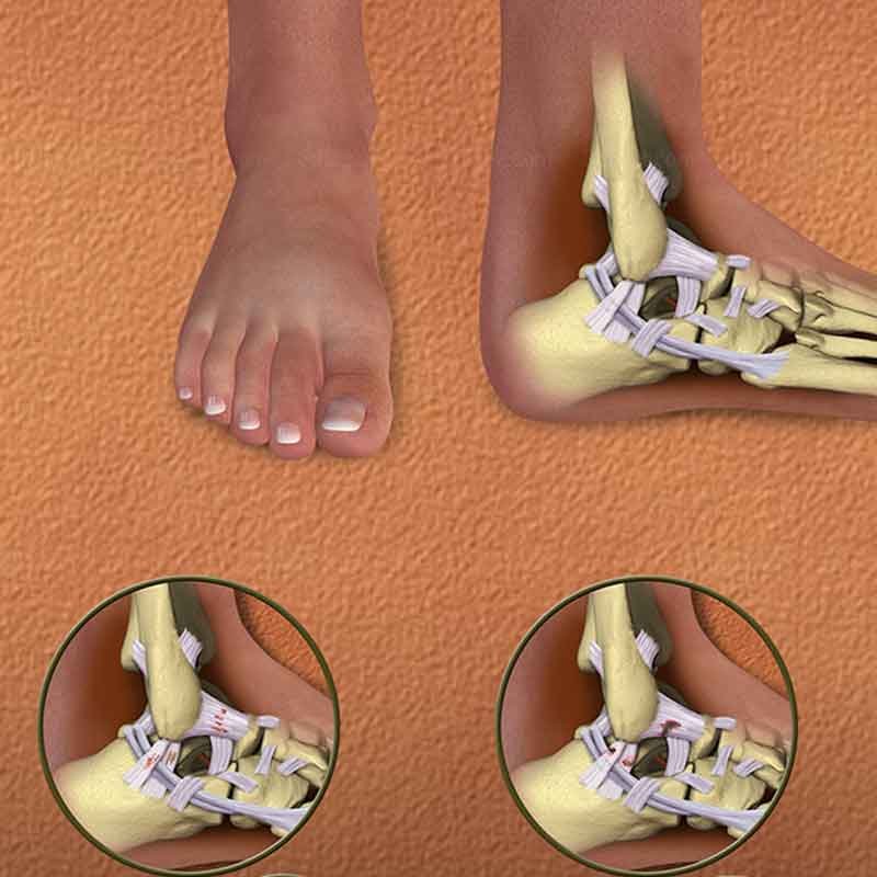 A 3D medical rendering  showing ankle sprain
