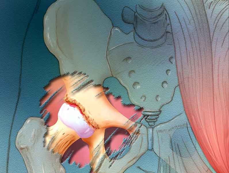 2d medical illustration showing hip arthrosis