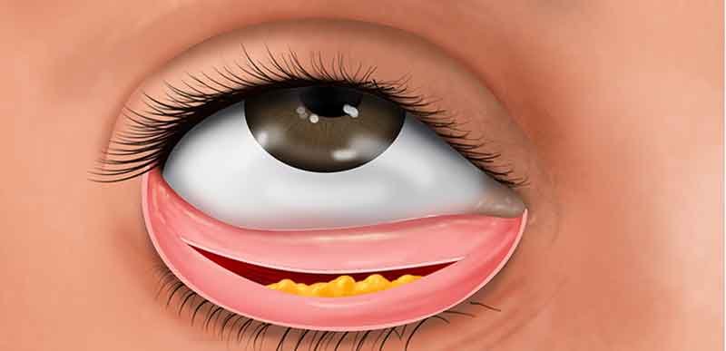 Medical illustration showing alveolar cleft repair surgery