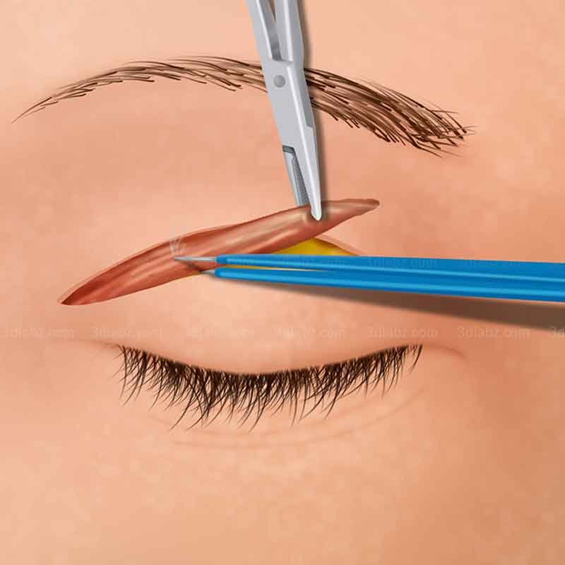 A 2D illustration showing blepharoplasty eyelid surgery