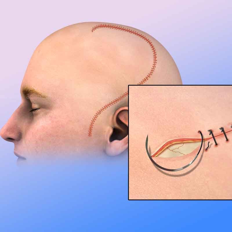 Cranioplasty Surgery 2D Medical Illustration