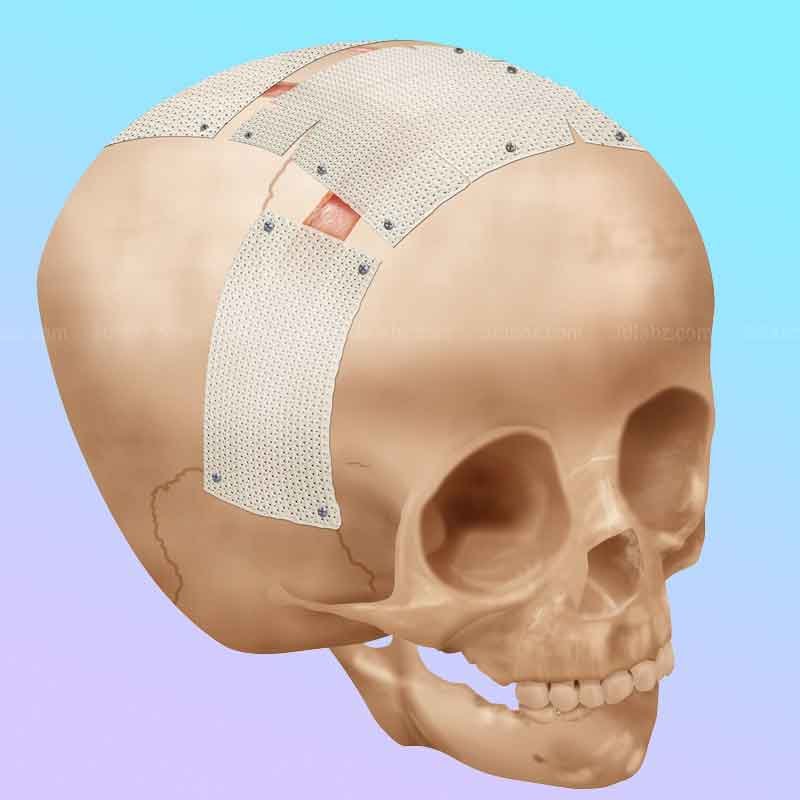 A 2D illustration on craniosynostosis surgery