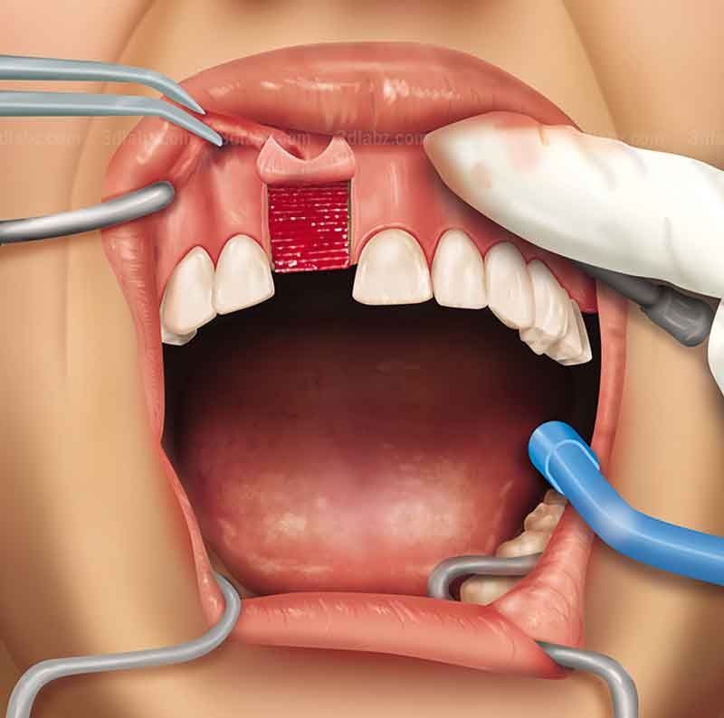 2D illustration showing dental surgery