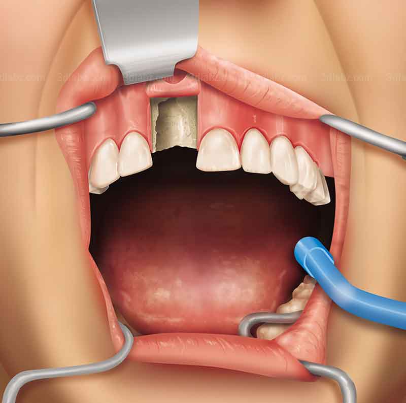 Illustration showing dental implant surgical procedure