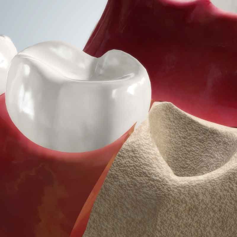 Dental ridge preservation 3D still render