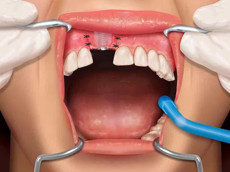3D rendered view from a dental surgery animation