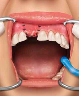 A still 3d render from immediate implant dental surgery animation