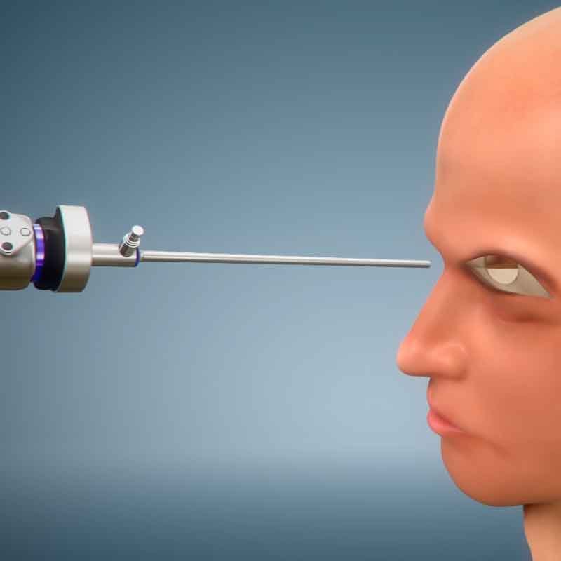3D still render from brain tumor removal surgery animation