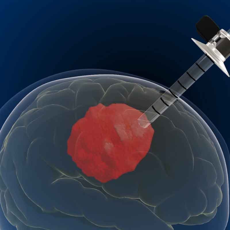 3D render image showing intracerebral hematoma endoscopic surgery