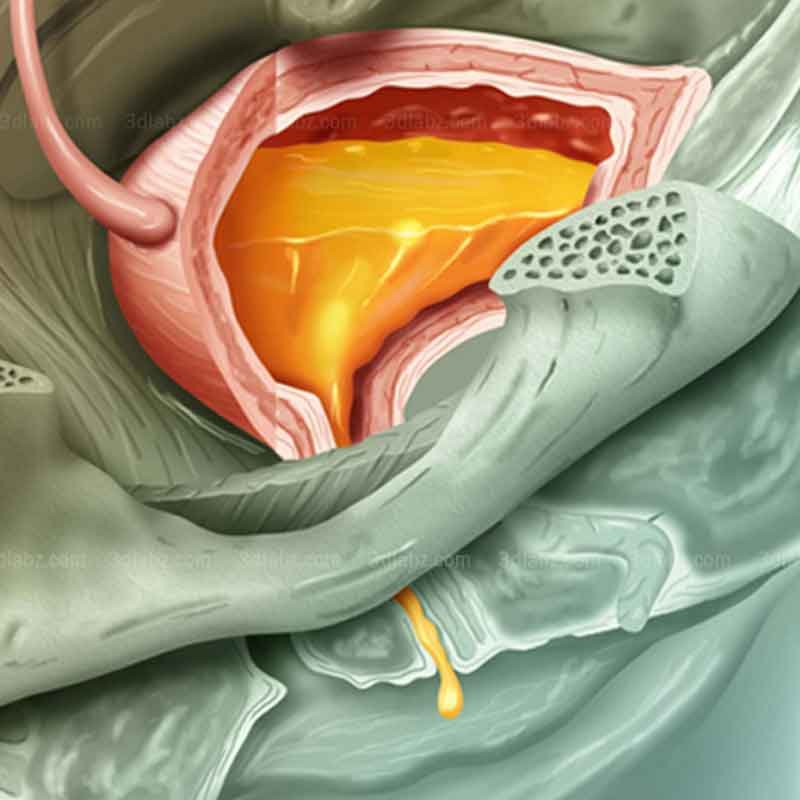 A 2D illustration showing female urinary incontinence