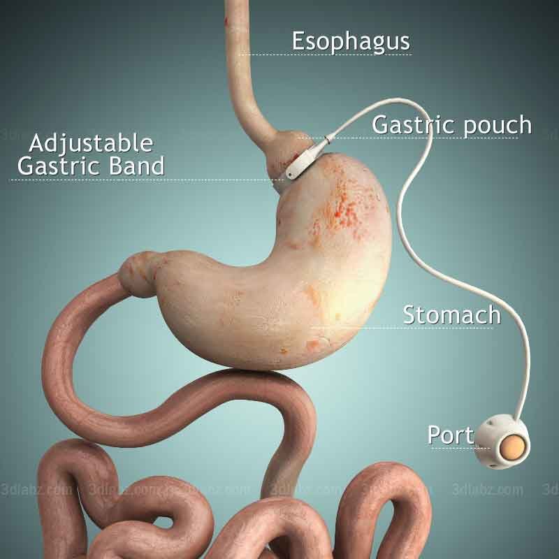 3D medical illustration showing gastric bypass pouch