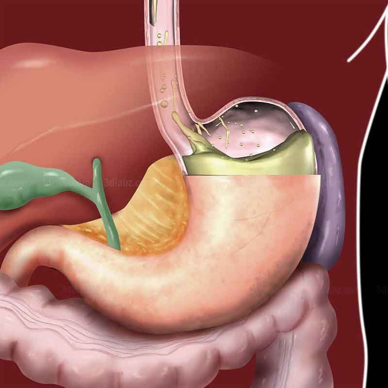 Gastroesophageal Reflux Illustration