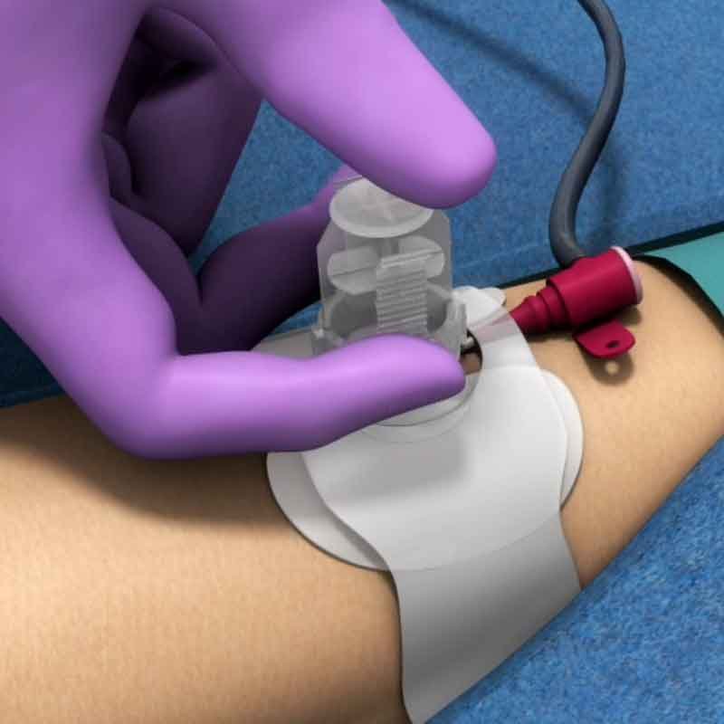A medical 3d render image showing hemostasis device