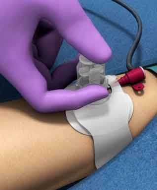 3D render image of hemostasis device used in radial artery catheterization