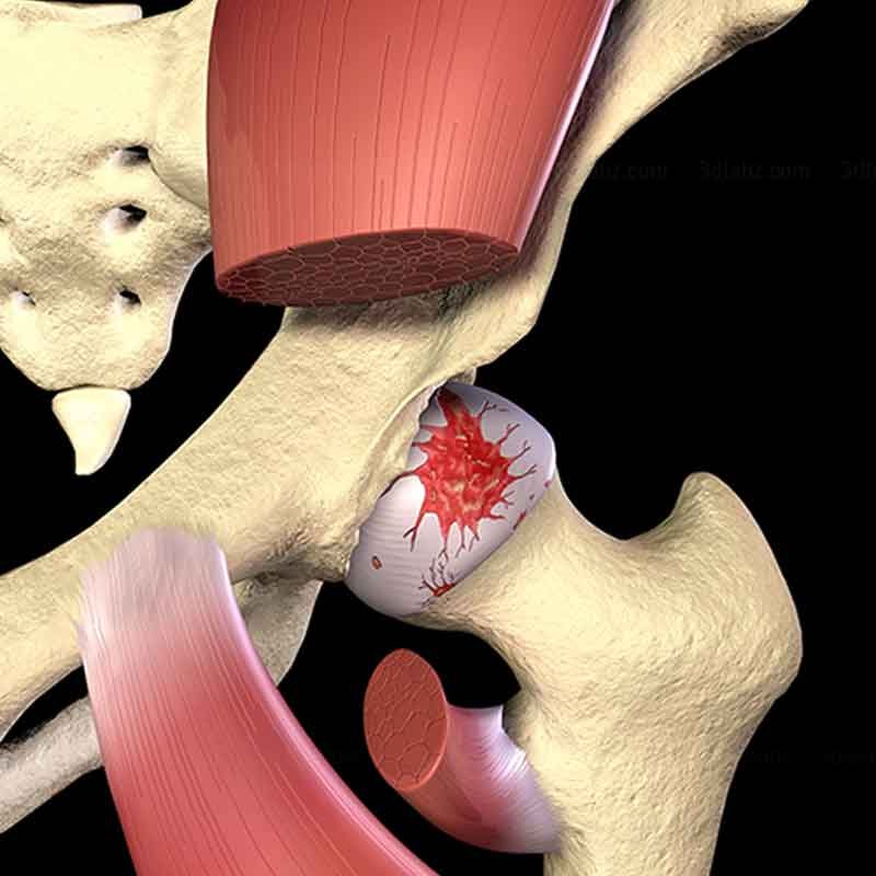 A 3D medical render image showing osteoarthritis on hip
