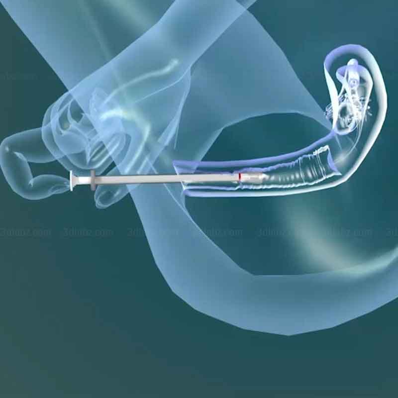 A 3D medical illustration showing how to use vaginal estrogen cream using a applicator