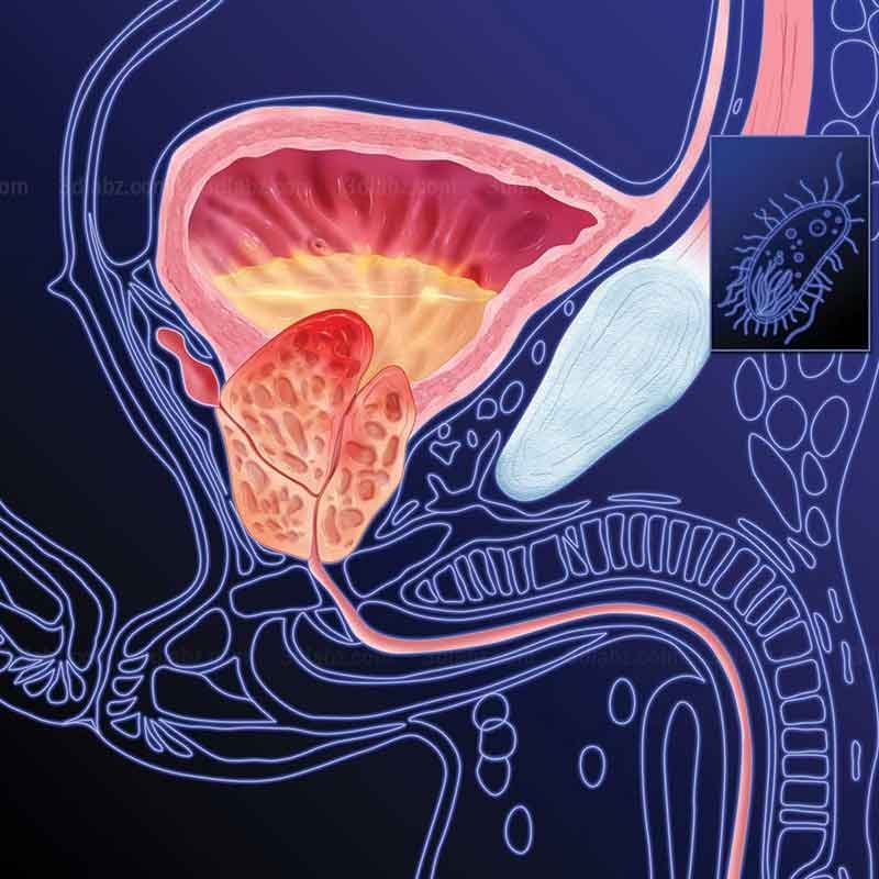 A 2D illustration showing prostate gland inflammation