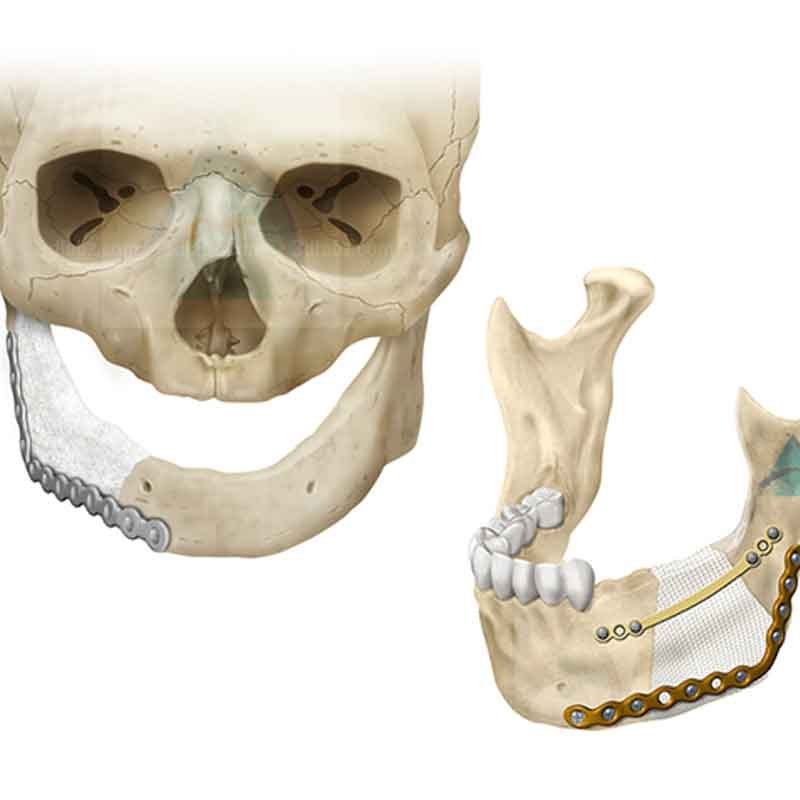 Mandible reconstruction 2D Illustration