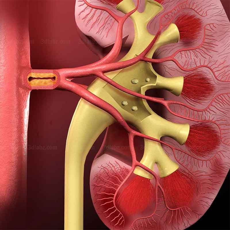 A 3D picture showing stones in Kidney