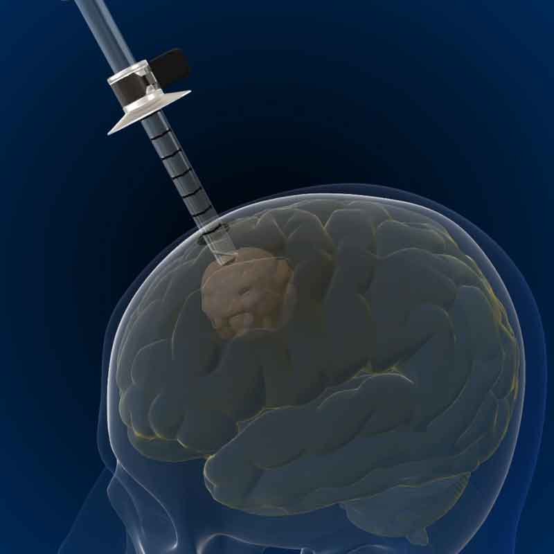 3D render image showing endoscopic brain tumor removal surgery