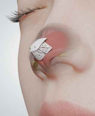3D render image nasal tip rhinoplasty surgery animation