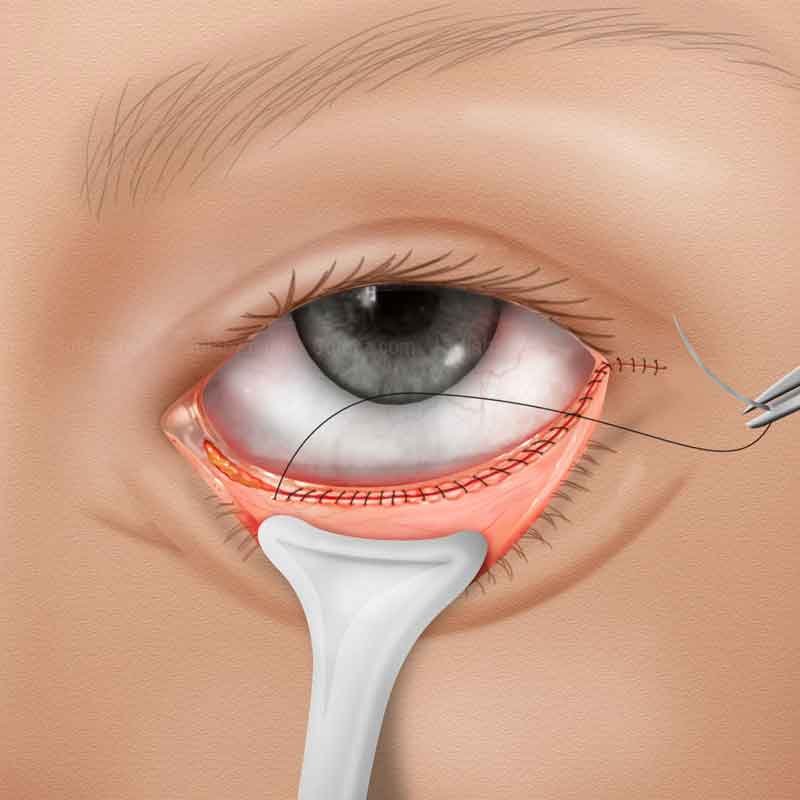 A 2D illustration showing orbital floor fracture surgery