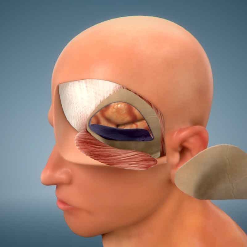 A still 3D render from pterional craniotomy surgery animation
