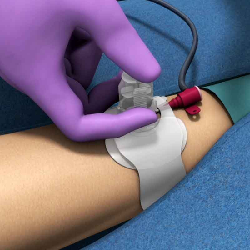 A 3D render from radial artery catheterization animation