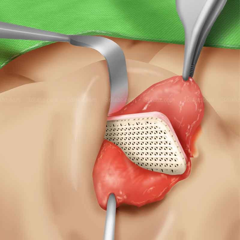 A 2D medical illustration showing rhinoplasty surgical procedure