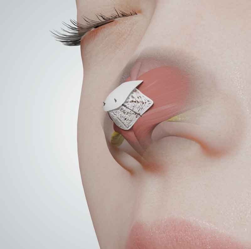 3D medical illustration for nasal tip surgery