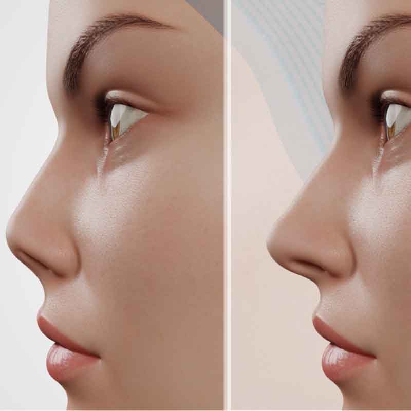 3D render image of nose before and after rhinoplasty surgery