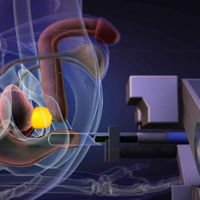 A 3D illustration render image showing robotic prostate biopsy procedure