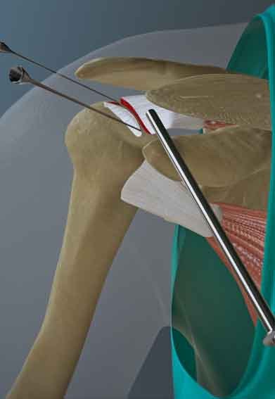 A 3d rendered image from rotator cuff tear repair surgery animation