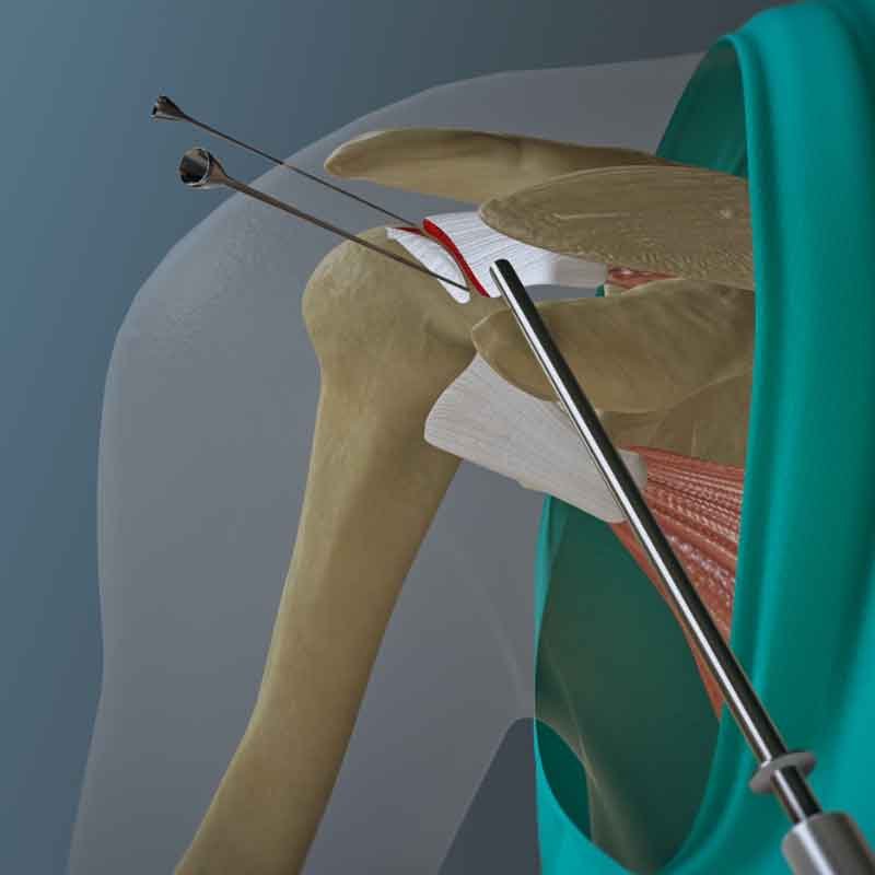 A still 3D render from rotator cuff tear repair animation
