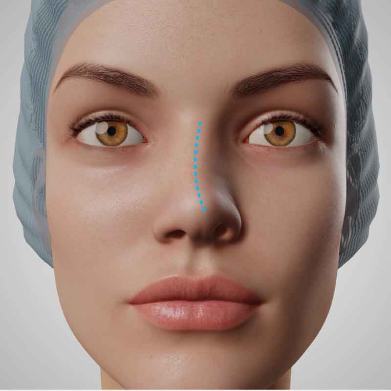 A 3D render view of a lady with curved nose for septoplasty surgery