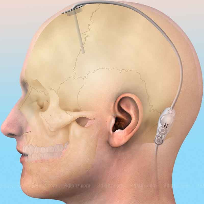 A medical illustration showing shunt insertion procedure