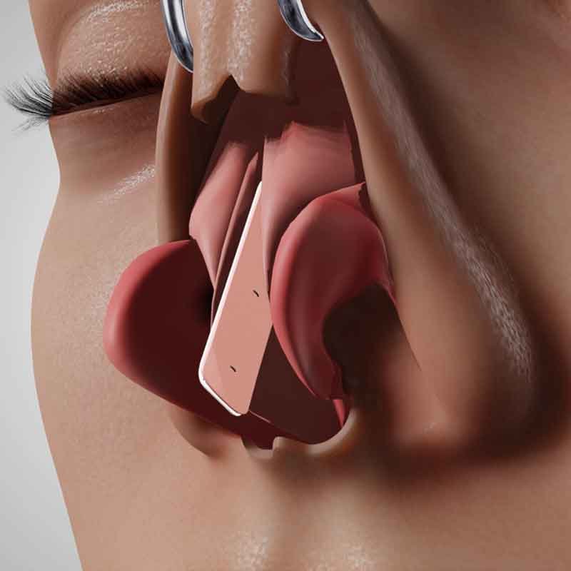 A 3D render view of a lady with curved nose for septoplasty surgery