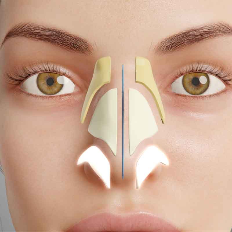 3D render view of a lady with nose hump in structural rhinoplasty