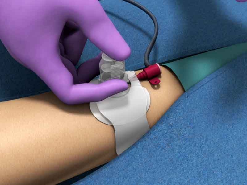 3D rendered view from a surgical procedure video