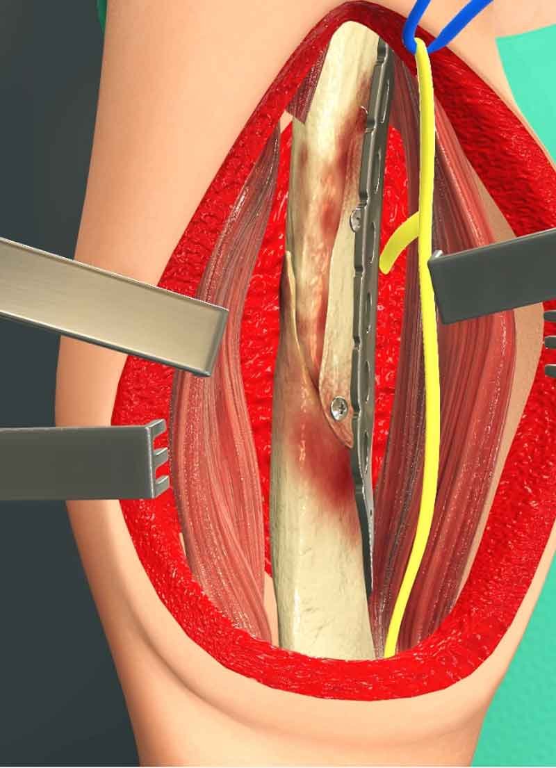 A 3D still render view from shoulder surgery animation