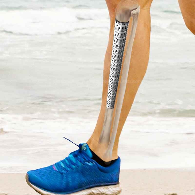 A medical 3d rendering showing regenerative implant on tibia fracture