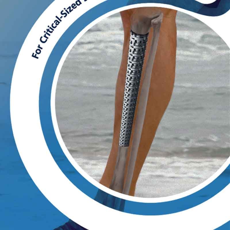 3D rendered image showing regenertative tibia implant